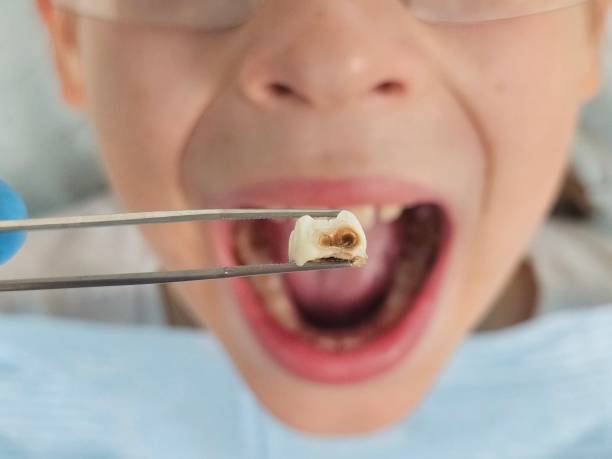 Best Knocked-Out Tooth (Avulsed Tooth) Treatment in Saltville, VA